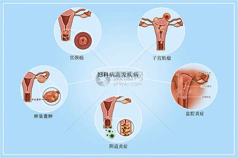 婦科病|妇科疾病（病症名称）